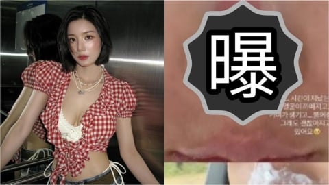 「水彈女王」權恩妃挑戰非洲高峰遭二度灼傷！「全臉紅腫」近況照曝光…