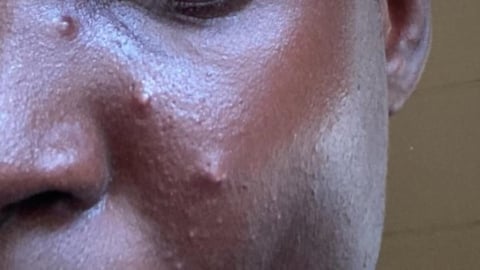 臉上痘痘別亂擠!醫示警「危險三角區」千萬別碰:一不小心就喪命