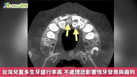 台灣兒童多生牙盛行率高 不處理恐影響恆牙發育與齒列