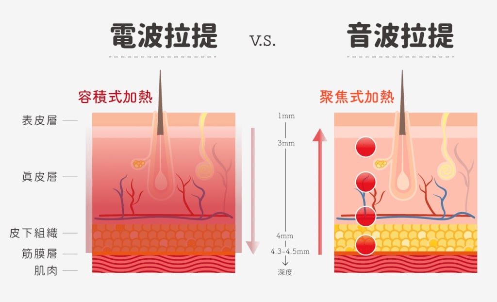 韓星權珉娥做醫美險毀容！醫揭電音波「舒眠麻醉」危機與防雷3關鍵