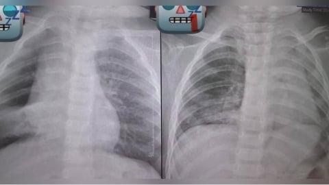 1歲童被餵整顆花生「肺部塌陷」！　醫氣炸曝：死死塞住支氣管