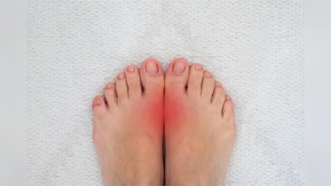 過年大魚大肉！想避免「痛風」掃興 醫示警「8大類人」，飲食「5方法」不發作