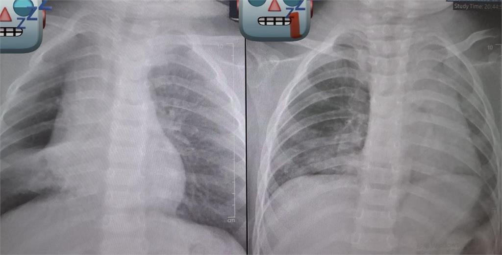 阿嬤餵孫整顆花生「卡氣管3天長肉芽」！見「肺塌陷」險喪命⋯醫師發文怒斥