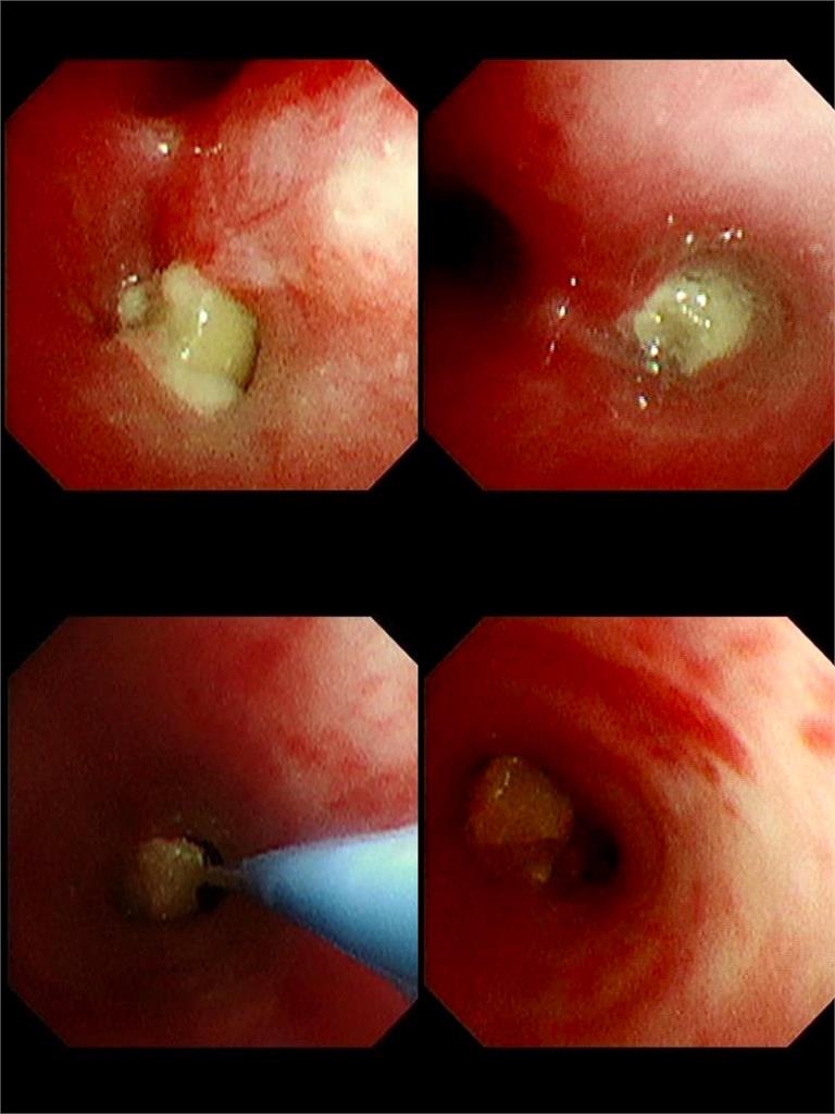 阿嬤餵孫整顆花生「卡氣管3天長肉芽」！見「肺塌陷」險喪命⋯醫師發文怒斥