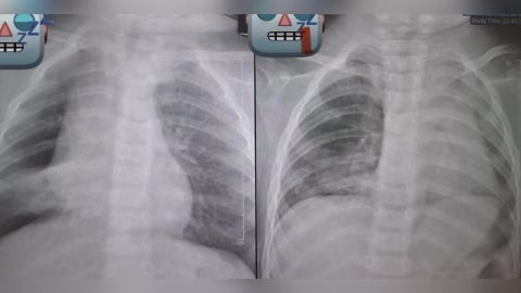 阿嬤餵孫整顆花生「卡氣管3天長肉芽」!見「肺塌陷」險喪命⋯醫師發文怒斥