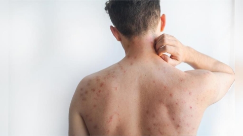 痘痘反覆長？別只顧殺菌！痘痘形成「4大原因」，醫揭「皮脂腺」可能過勞了