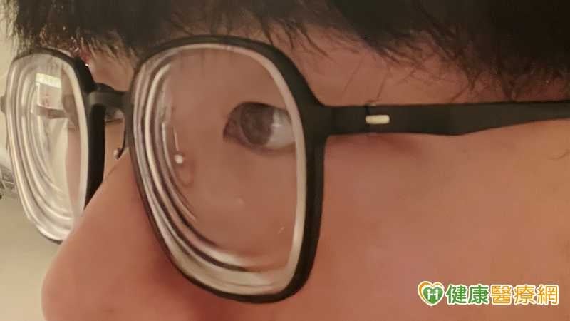 溫差、狂風樣樣來　隱眼族雙眸乾刺紅通通？醫：佩戴少1動作超NG