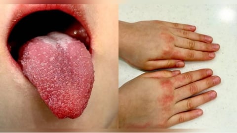 4歲妹高燒4天張口驚見「草莓舌」　醫示警快送急診：恐釀心臟後遺症