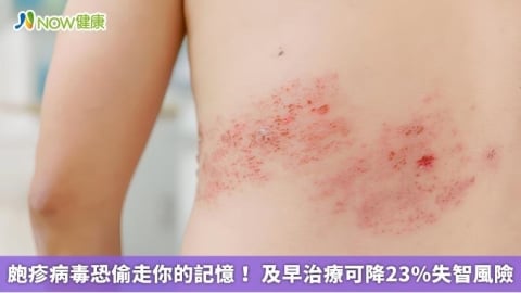 皰疹病毒恐偷走你的記憶! 及早治療可降23%失智風險
