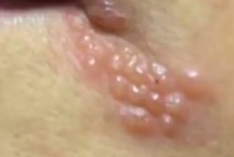 嘴角長皰疹竟然會引發腦炎？30歲老闆娘腦死震撼網：免疫力低下是關鍵點