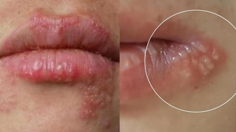 嘴角長皰疹竟然會引發腦炎？30歲老闆娘腦死震撼網：免疫力低下是關鍵點