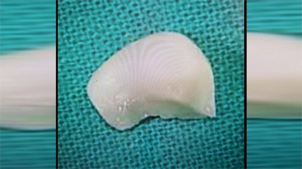 罕見！高雄女遭瑪爾濟斯狠咬　「狗牙卡眼」險失明