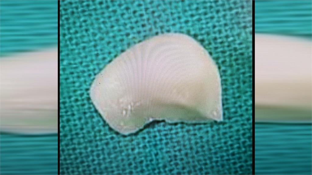 罕見！高雄女遭瑪爾濟斯狠咬　「狗牙卡眼」險失明