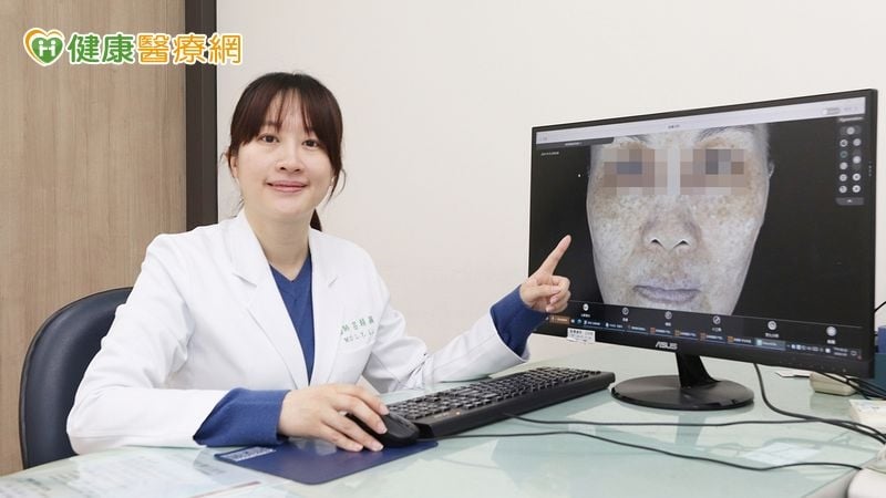 肝斑誤當黑斑!自買療程打斑卻愈打愈黑 客製化治療助恢復好臉色