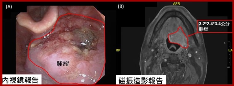 7旬阿祖口咽癌2度敲門 SBRT精準治療開啟抗癌新曙光