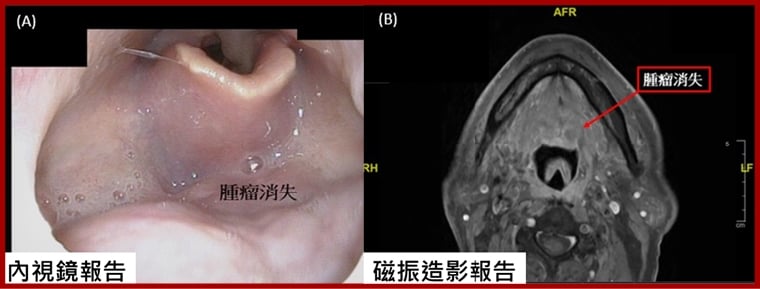 7旬阿祖口咽癌2度敲門 SBRT精準治療開啟抗癌新曙光