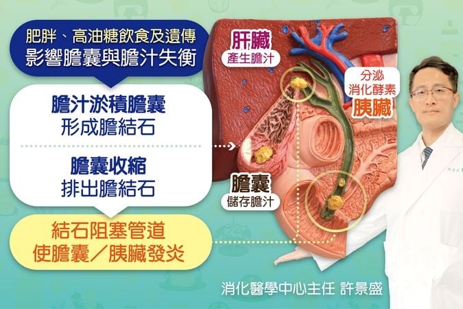 「4F族群」易患膽結石 醫:「這些飲食習慣」恐增加風險!