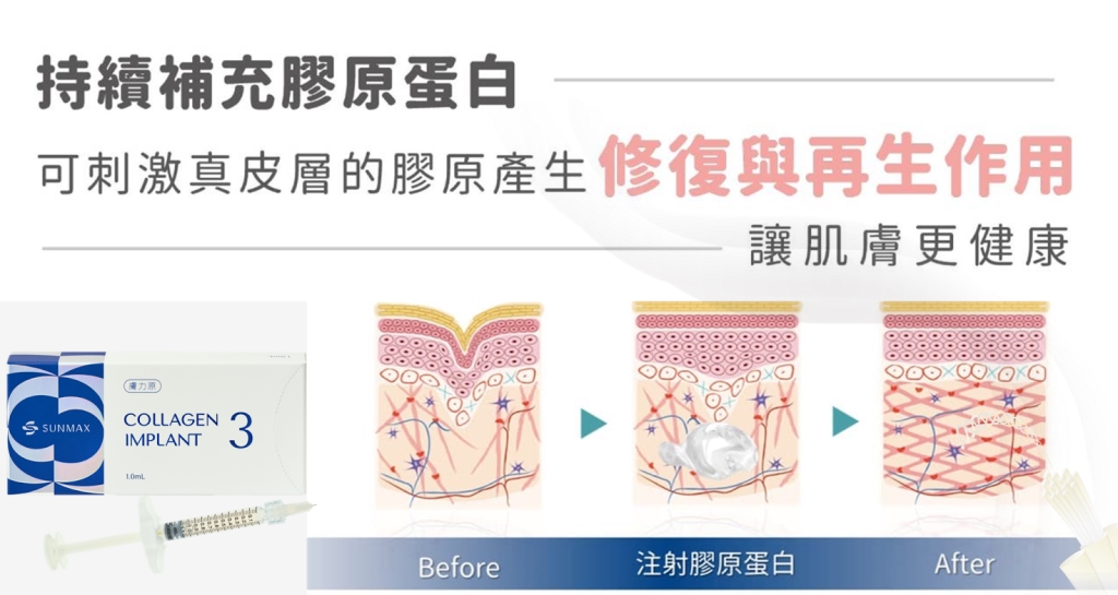 20歲就有淚溝黑眼圈？ 醫揭「熊貓針」席捲Z世代主因