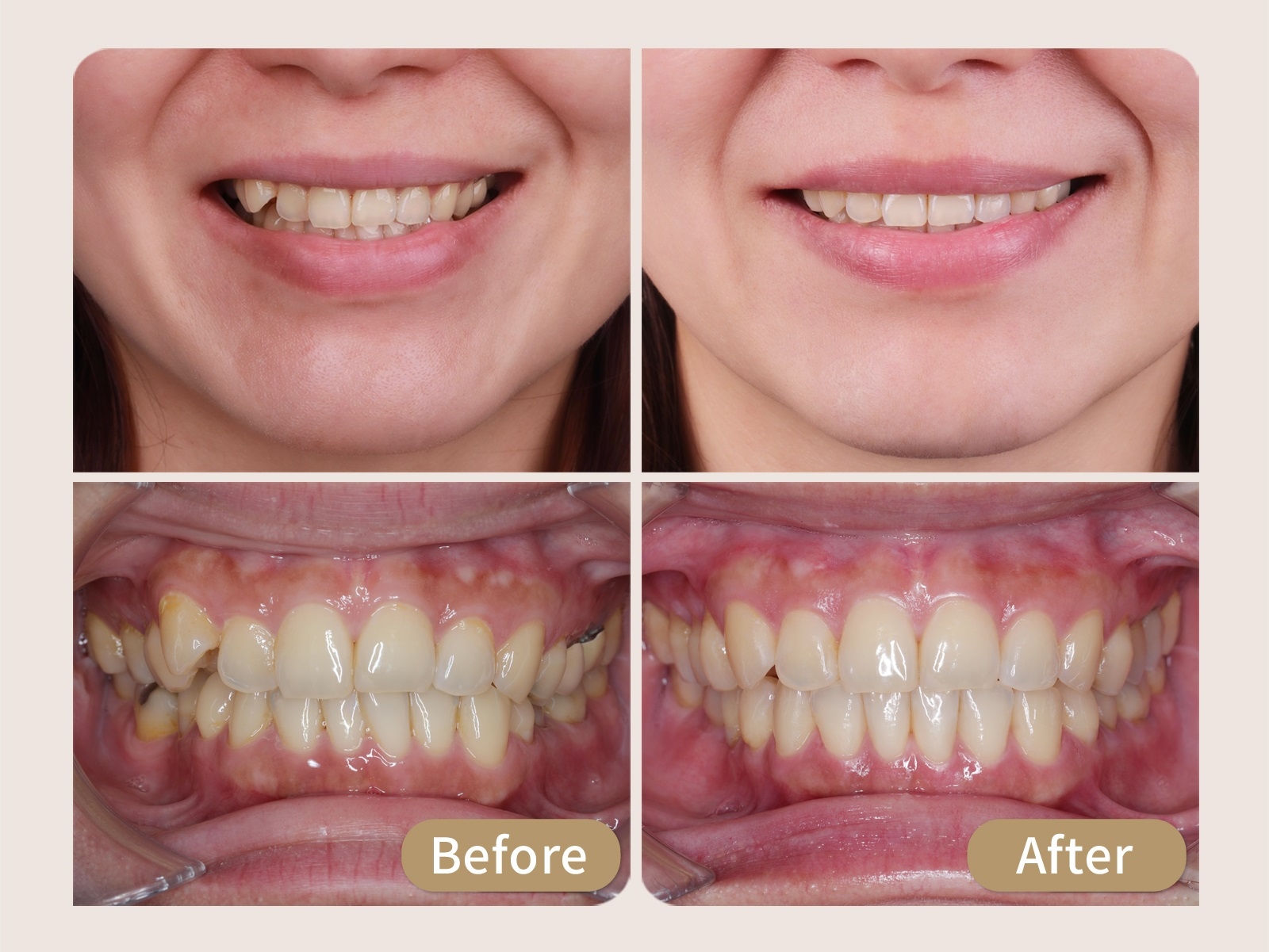 「先矯正後植牙」搭數位監控 跨專科合作需求一次滿足
