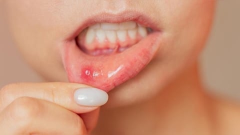 嘴巴破洞越變越大？反覆發作恐是免疫警訊！快補4大營養素