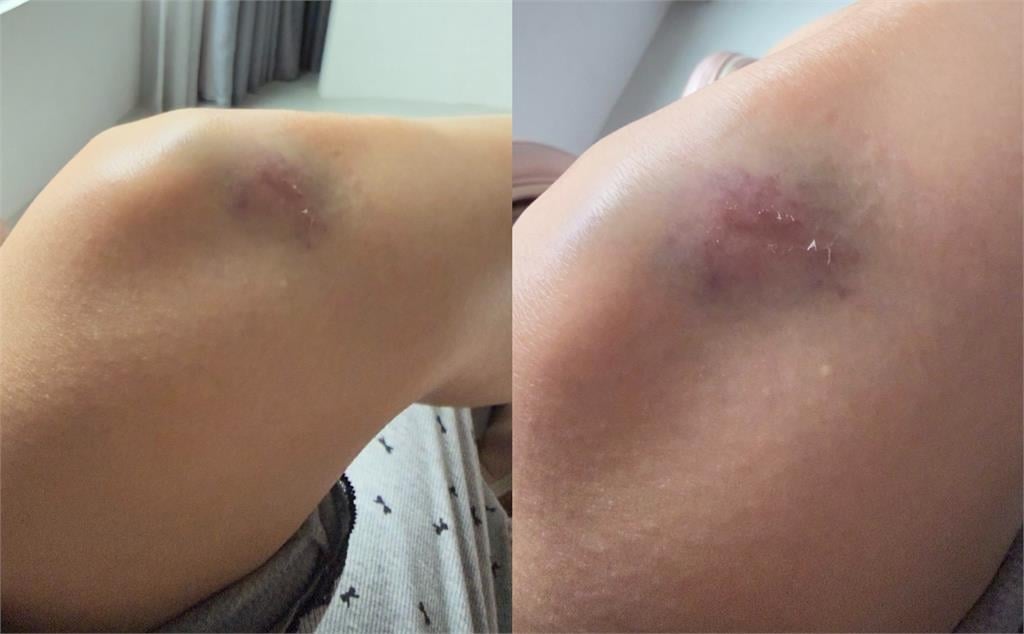 曾莞婷突爆「拍戲出事」！流出「雙膝大片傷勢」粉急關切：要小心