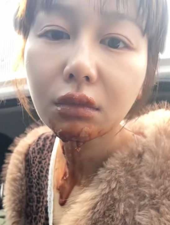 大陸女演員王添羽模仿網路流行的「生日噴火拍照法」發生意外，導致下巴及頸部燒傷。（圖／翻攝自微博）