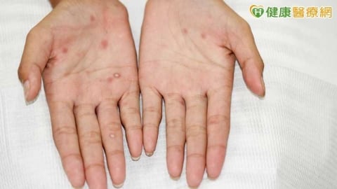 15至24歲去年梅毒確診數增近2千例 疾管署揭主因並籲善用1資源