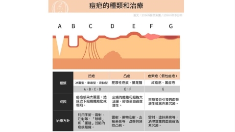 痘疤為何難消？解析紅疤、黑疤與凹疤差異：常見方式一次了解