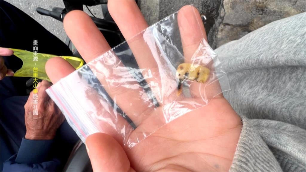 阿公嗑水煎包「內餡藏齒狀硬物」人掉的?原主人「恐患牙周病」醫證實了