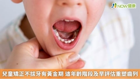 兒童矯正不拔牙有黃金期 這年齡階段及早評估重塑齒列