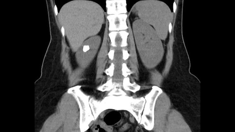 腰痛、反覆泌尿道感染？醫：恐為結石 微創手術可解決