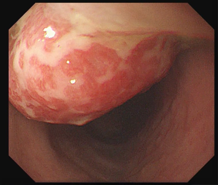 1至7歲孩童血便、生長停滯 恐為幼年型大腸息肉作祟