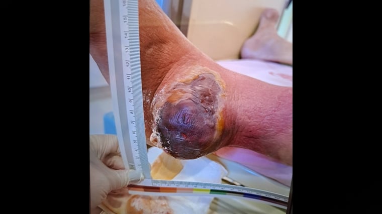 雞蛋大痛風石破裂驚人！ 醫示警：長期尿酸值失控導致 