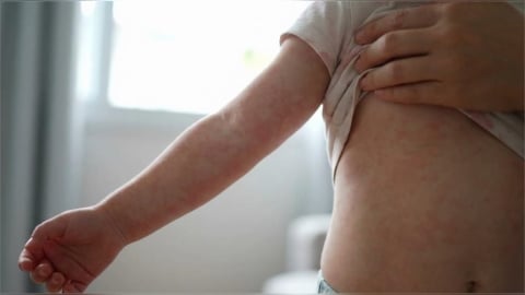 玫瑰疹只有退燒才長？與病毒疹差異在哪？會復發嗎？醫教7招判斷