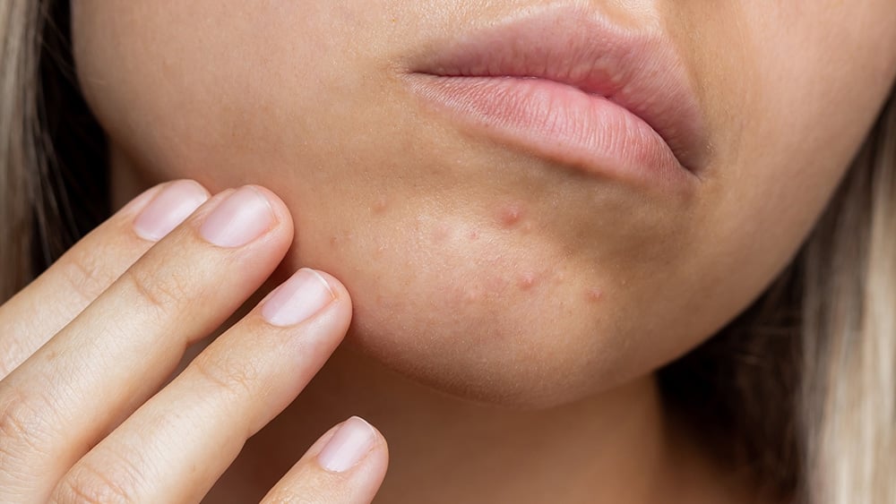 粉刺怎麼清？醫師教你正確處理方式避免毛孔粗大