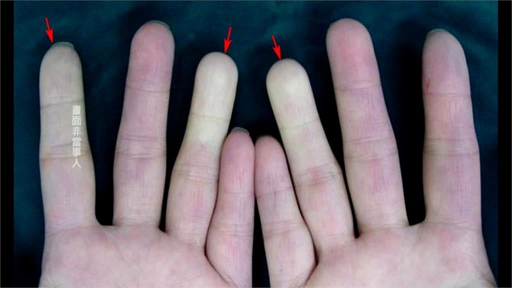 手指變紫別大意！　　竟是「全身性硬化症」作祟死亡率高