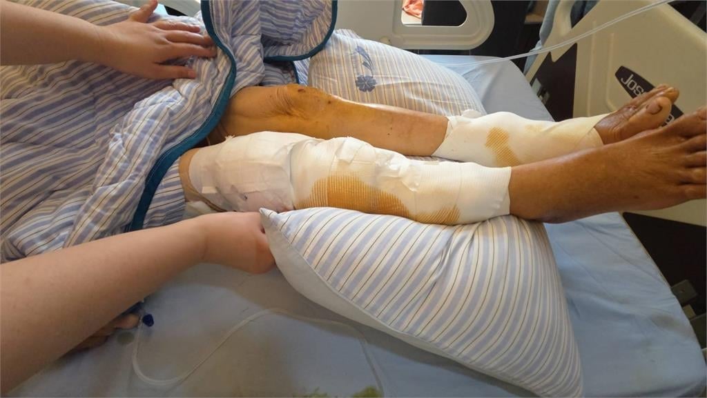 彰化埤頭驚傳惡犬咬人　老婦慘遭群攻200多處傷