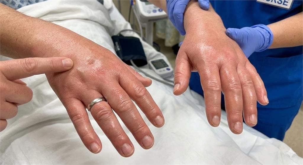 72歲詹老師「手腫」發病到過世僅1天！醫示警「1症狀」：超危險