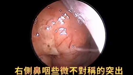 她以為只是長期「慢性鼻竇炎」　醫驚揪「極微小不對稱」竟是鼻咽癌！