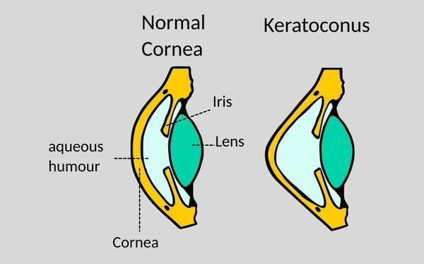 2旬女看不清竟是「角膜變形」！醫：圓錐角膜恐釀失明　高風險群「勿揉眼」