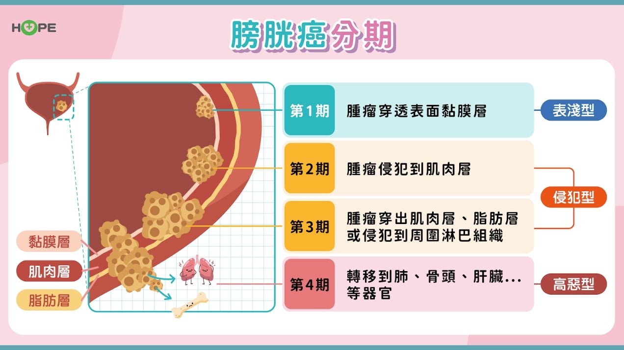 膀胱癌最新治療！晚期轉移也能拒絕高死亡率