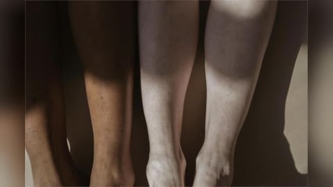 她一年來「鞋子買大兩號」  腎臟出問題？其實淋巴水腫作怪