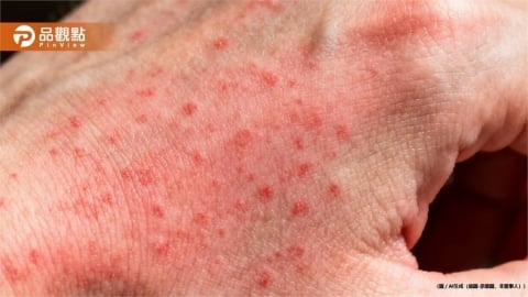 全身起紅疹！男童露營後高燒39度確診恙蟲病