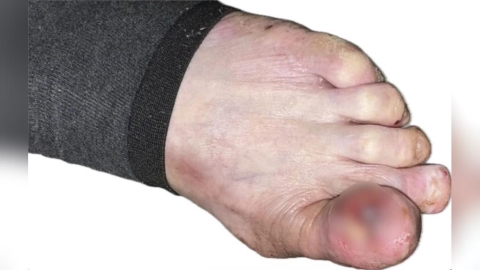 腳趾紅腫、化膿一年多難穿鞋   婦人「惡癌」錯當甲溝炎險丟命！