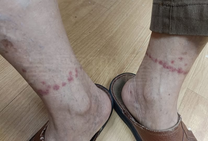 雙腳踝突冒「一圈圈紅疹」不是過敏！醫警告「1恐怖排列」：蟲一路咬出來
