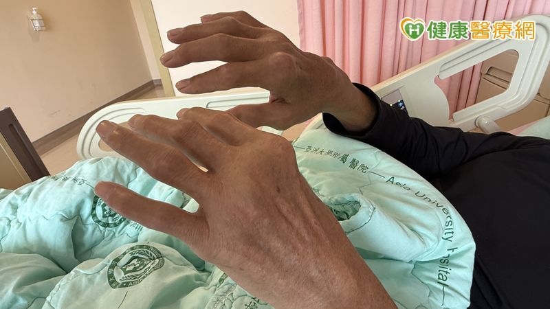 雞蛋大般的痛風石破裂有如爆漿！醫師警告：長年忽視恐釀截肢悲劇