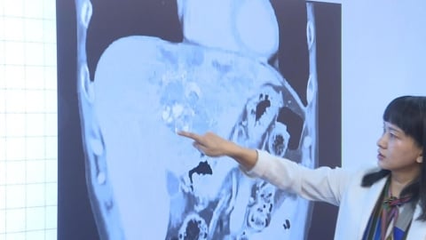 被宣告嘸效　台中肝癌末期病患　科別合併治療成功逆轉