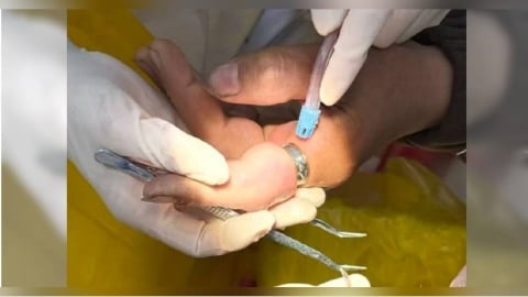 女子戒指太緊「手指腫脹發黑」險截肢　消防員沒轍！牙醫驚險解危