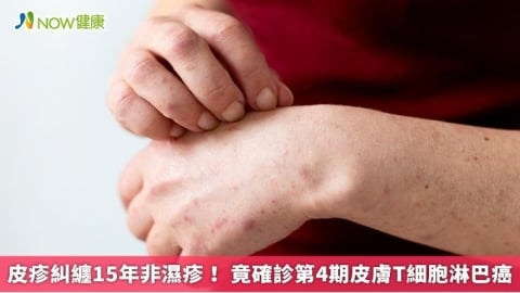 皮疹糾纏15年非濕疹! 竟確診第4期皮膚T細胞淋巴癌
