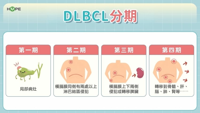 復發不用怕!瀰漫性大B細胞淋巴癌新武器來了 治療有新招